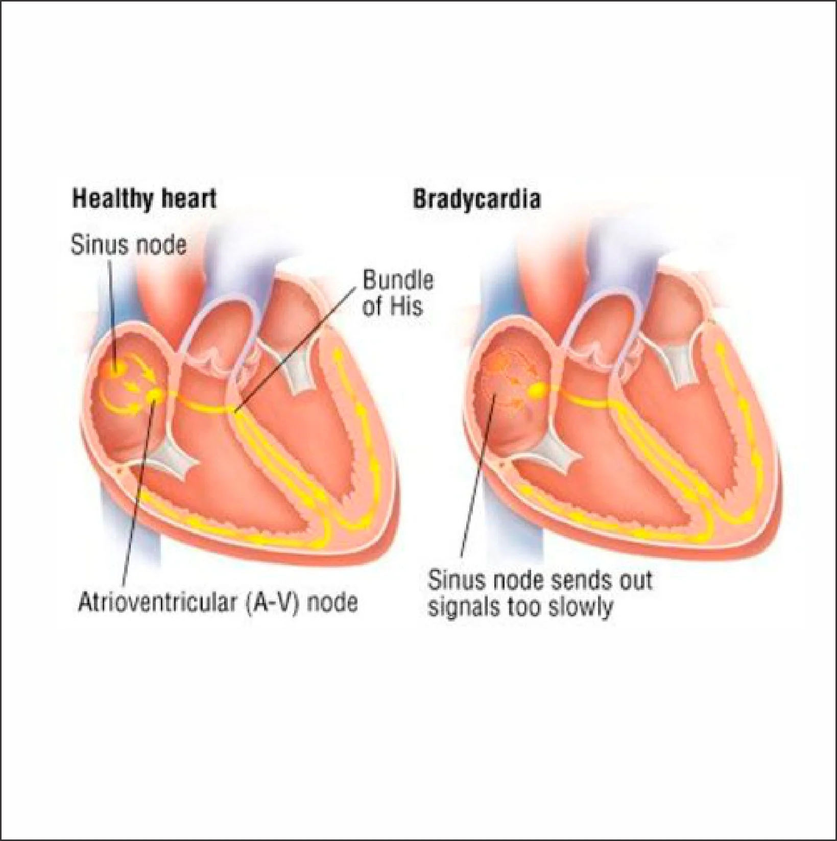 Best Treatment for Bradycardia at Gangasheel Hospital - Bareilly
