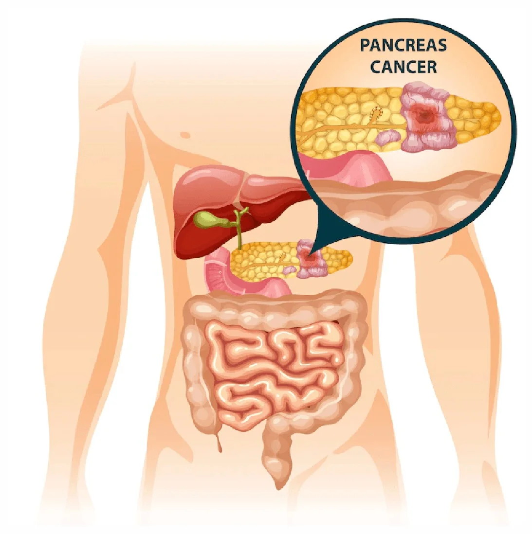 Best Treatment for Pancreatic Cancer at Gangasheel Hospital - Bareilly