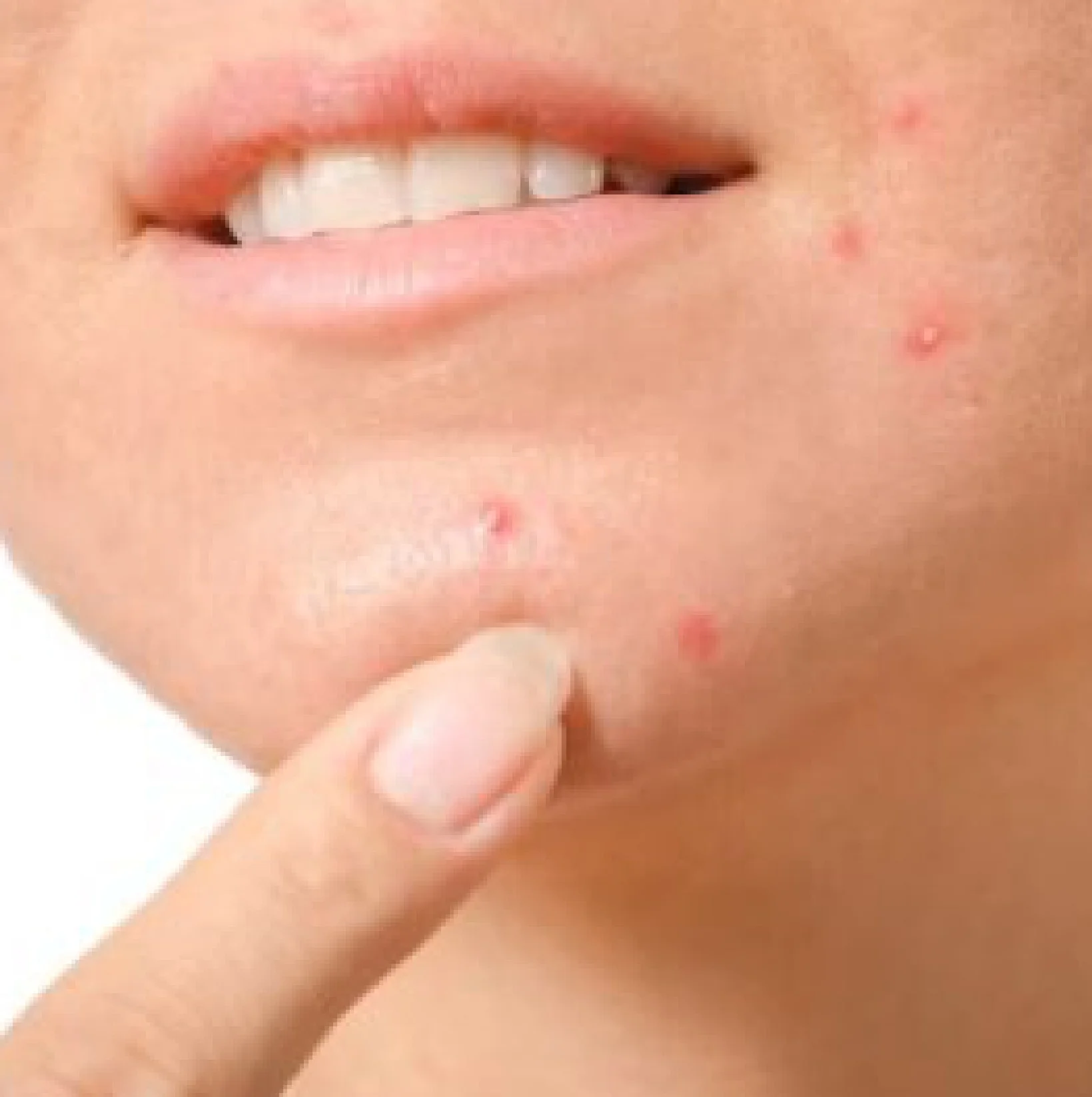 Best Treatment for Pimples at Gangasheel Hospital - Bareilly