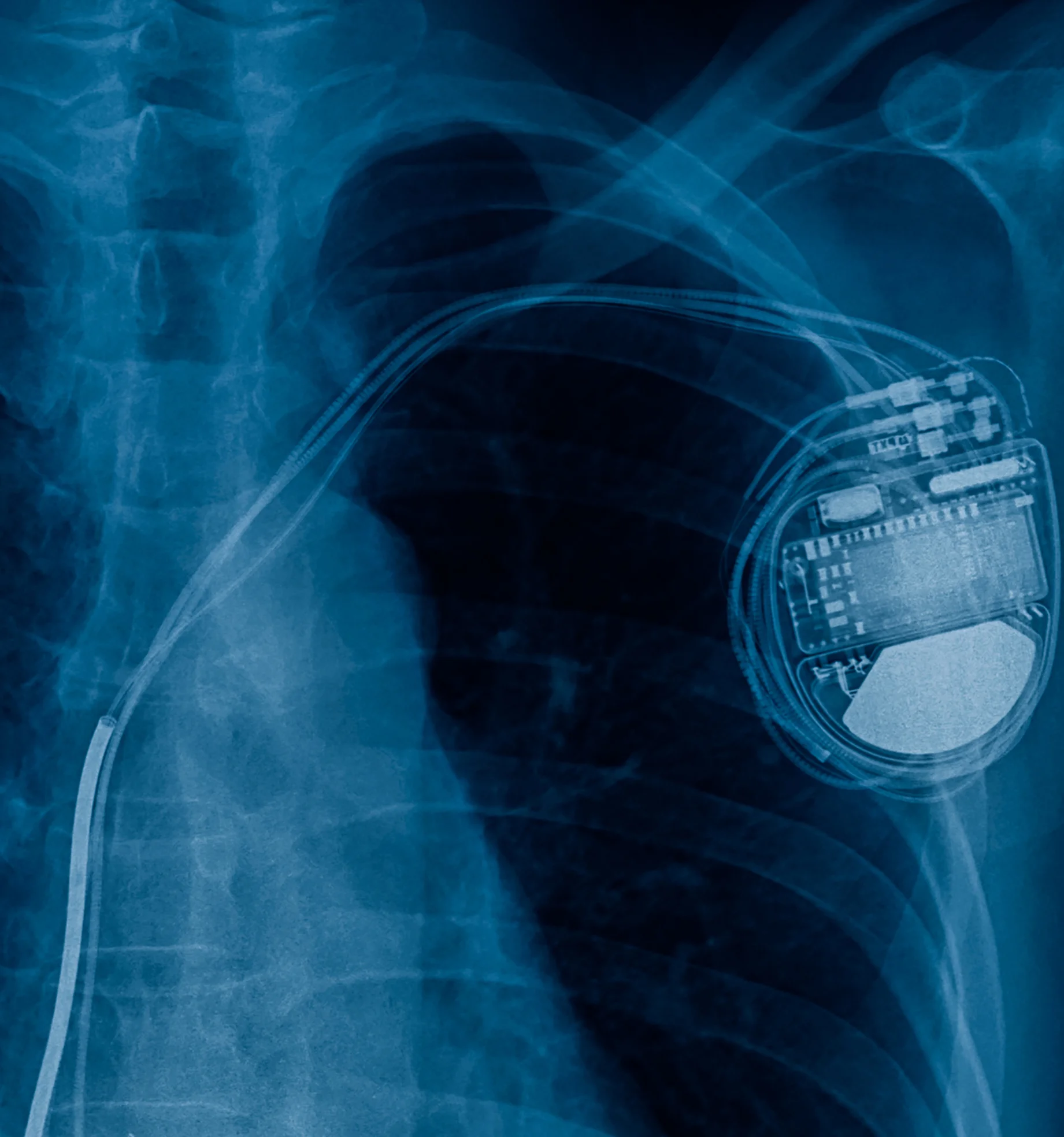 Best Treatment for Pacemaker Implantation at Gangasheel Hospital - Bareilly